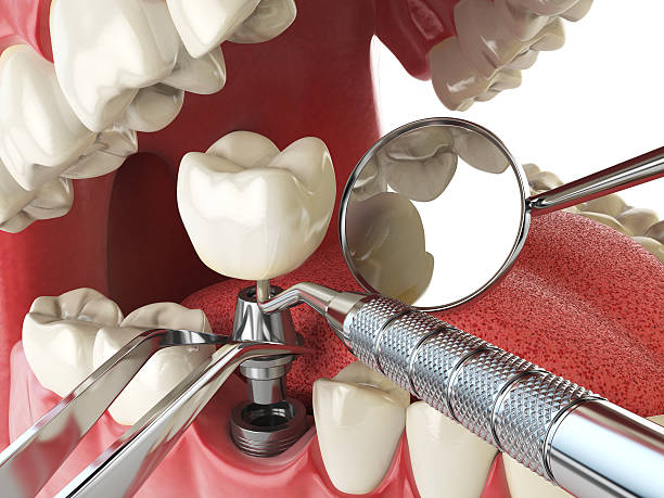 Best Emergency Treatment for Dental Infections or Abscesses in Rockford, MN
